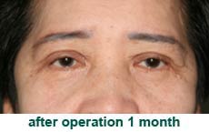 plastic-surgery-blepharoplasty